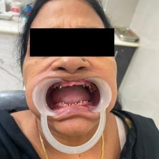 Patient 1 Edentulous Jaw Before Treatment